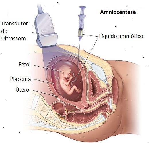 Exame De Dna Na Gravidez Não Invasivo Preço