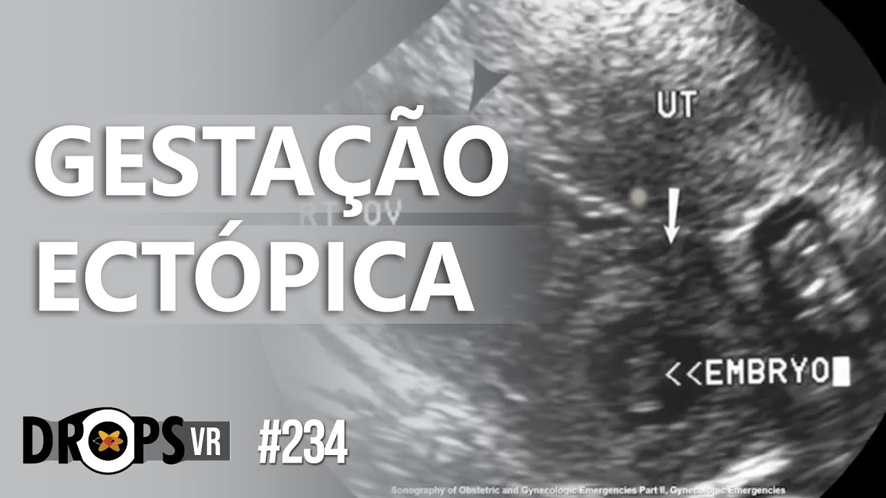 Gravidez Ectópica Aparece No Ultrassom Com Quanto Tempo Maternidade And Hospital Octaviano Neves 
