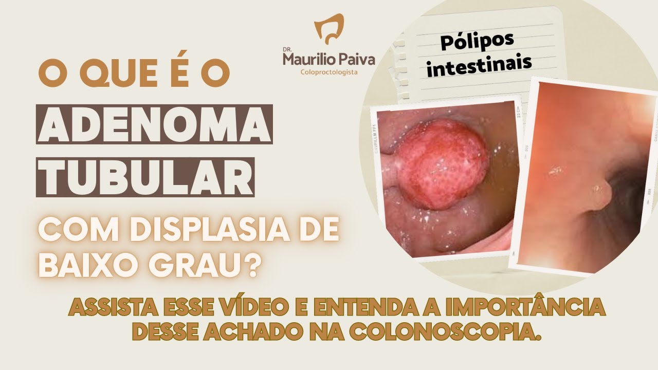 adenoma tubular com displasia de baixo grau