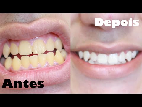 como clarear os dentes