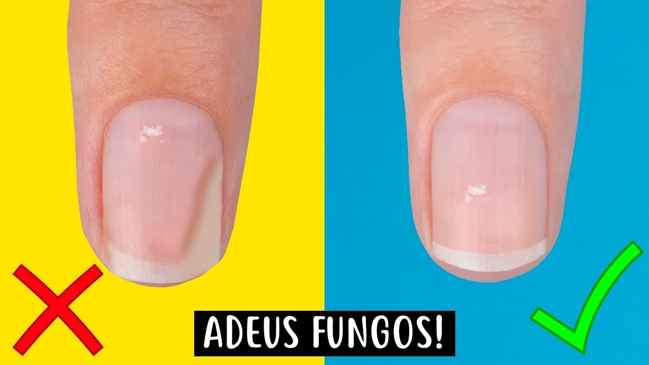 como acabar com fungos nas unhas rapidamente