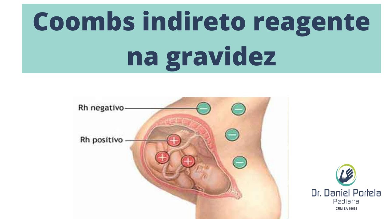 Teste De Coombs Indireto Na Gravidez Maternidade And Hospital Octaviano Neves 