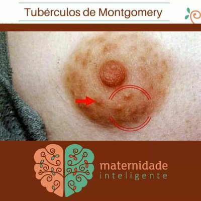 Tuberculos De Montgomery No Inicio Da Gravidez