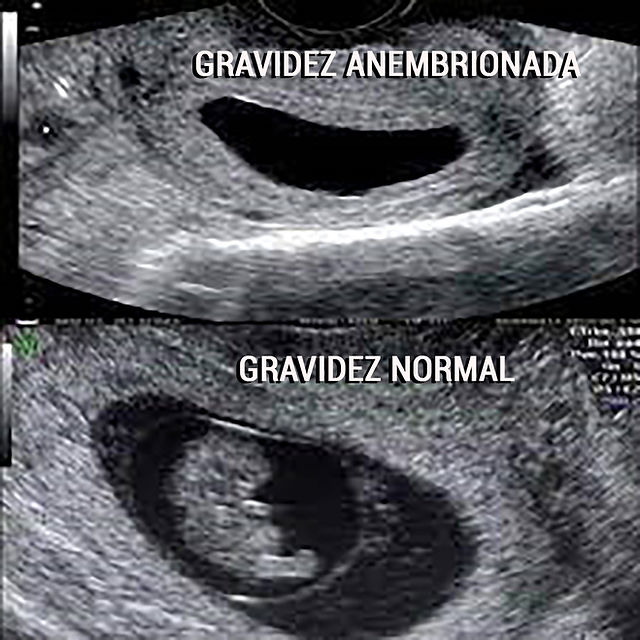 O Que é Gravidez Anembrionada Maternidade And Hospital Octaviano Neves 