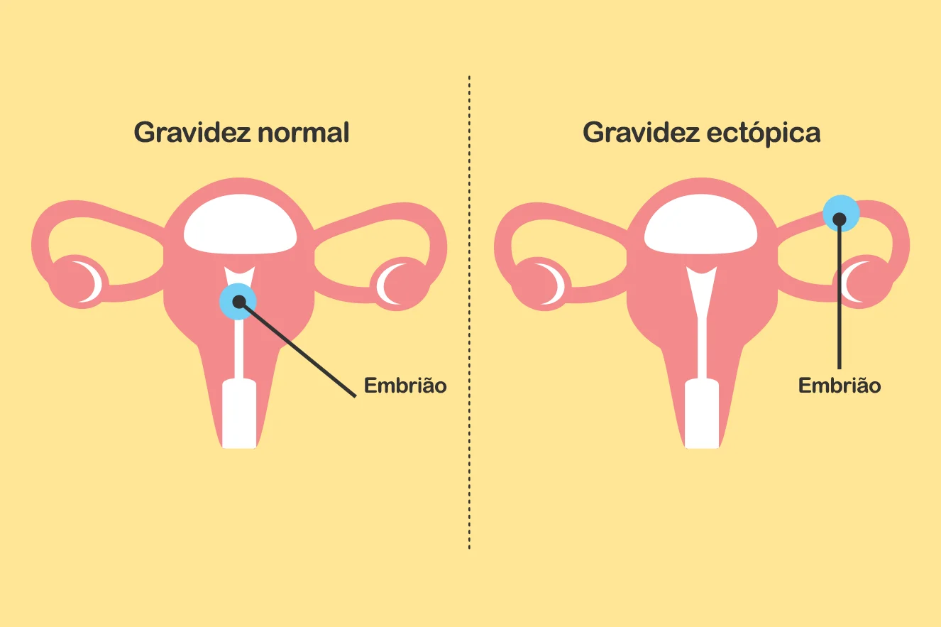 O Que é Gravidez Ectópica Maternidade And Hospital Octaviano Neves 