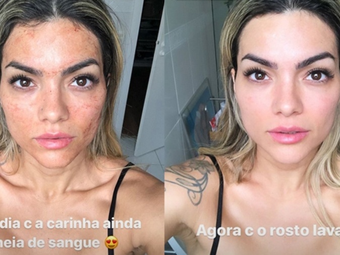 tratamento com plasma no rosto antes e depois