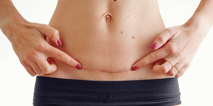 How Long Does It Take for a C-Section to Heal?