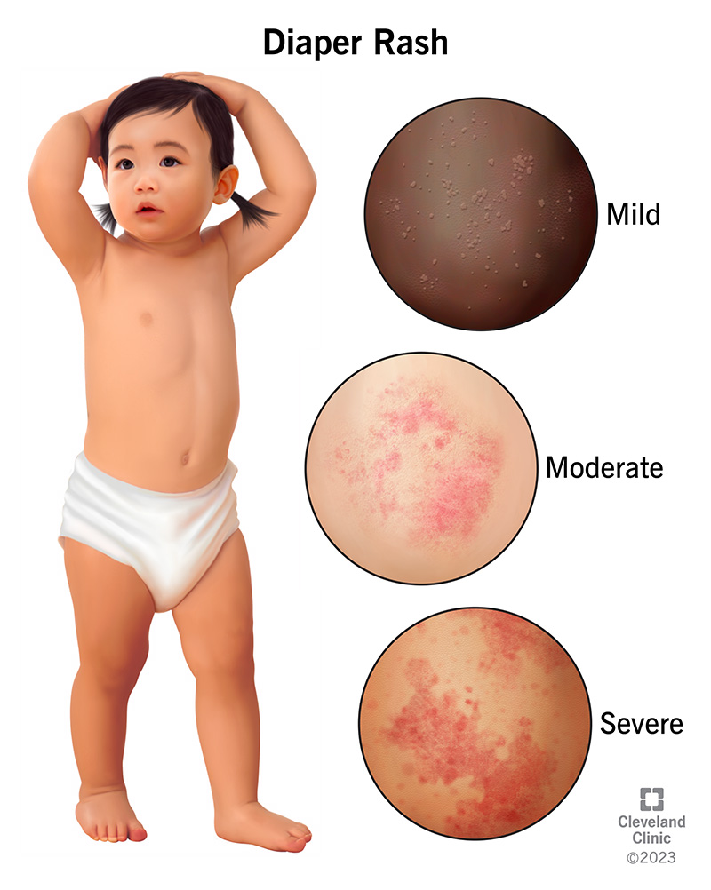 How Long Does It Take for Diaper Rash to Heal?